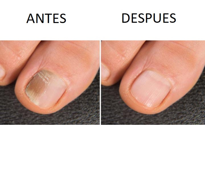 3X1 Parche Elimina Hongos en Uñas Pack 3 Cajas de 16 unidades