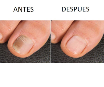 3X1 Parche Elimina Hongos en Uñas Pack 3 Cajas de 16 unidades